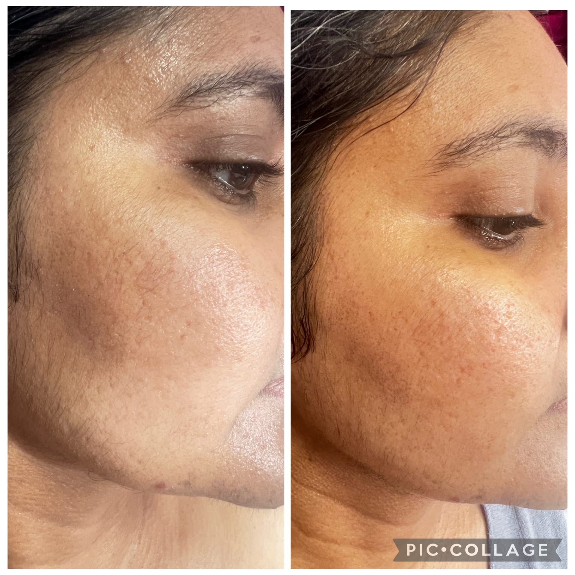 Facial Before & After